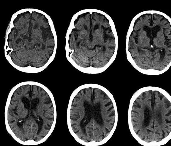 新澳今天最新資料大全和送小腦萎縮兒子高考與小腦萎縮能上學嗎